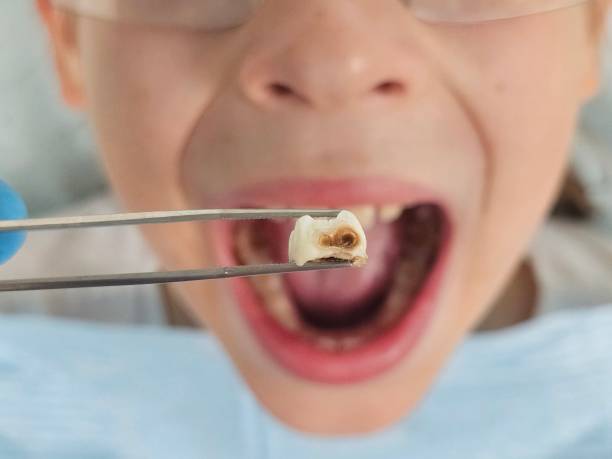 Best Emergency Tooth Extraction in Westmoreland, TN